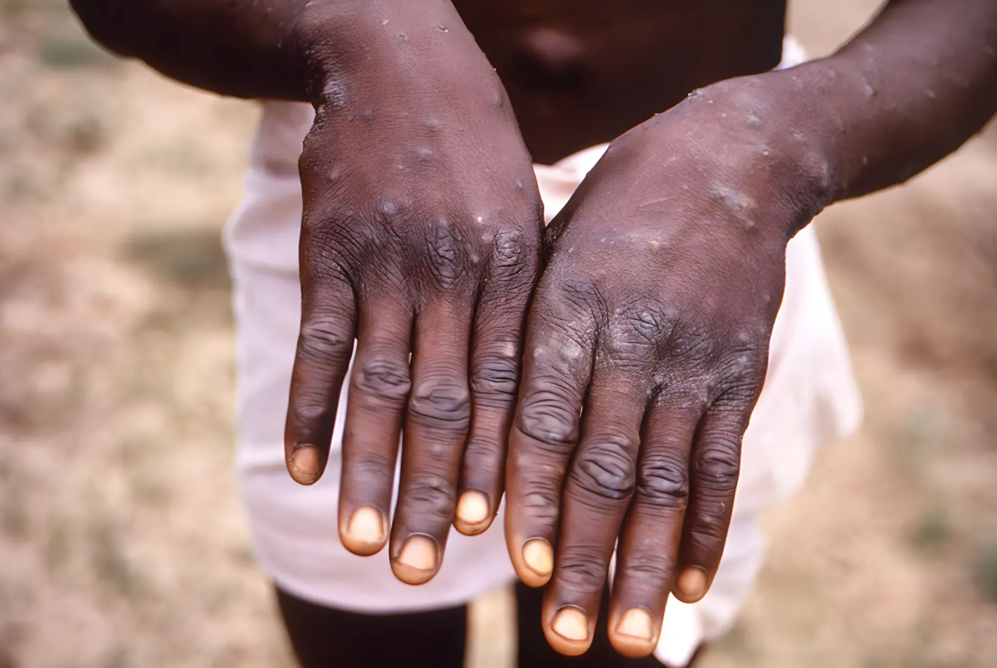 Among the most notable symptoms of Mpox are lesions that appear on the skin | Mpox Symptoms, Diagnosis, & Prognosis: Critical Facts You Need to Know | Mania Health